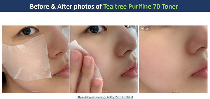 The Mildest Tea Tree TonerㅣKorean Skin CareㅣDr.Ceuracle