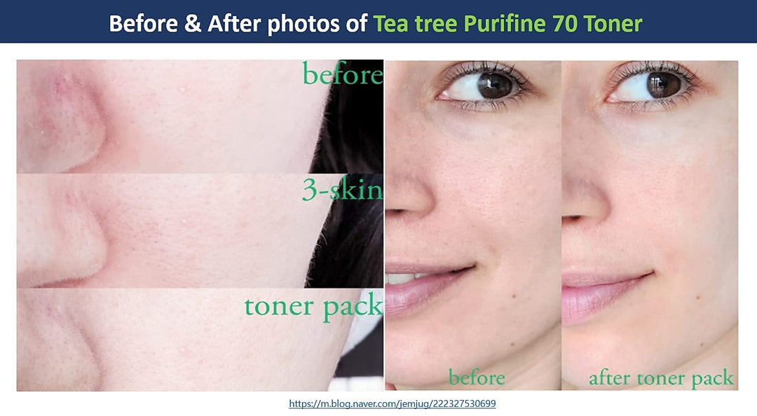 The Mildest Tea Tree TonerㅣKorean Skin CareㅣDr.Ceuracle