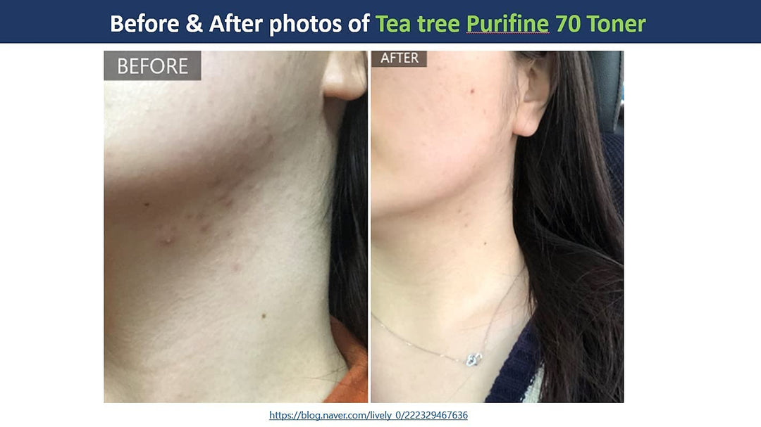 The Mildest Tea Tree TonerㅣKorean Skin CareㅣDr.Ceuracle